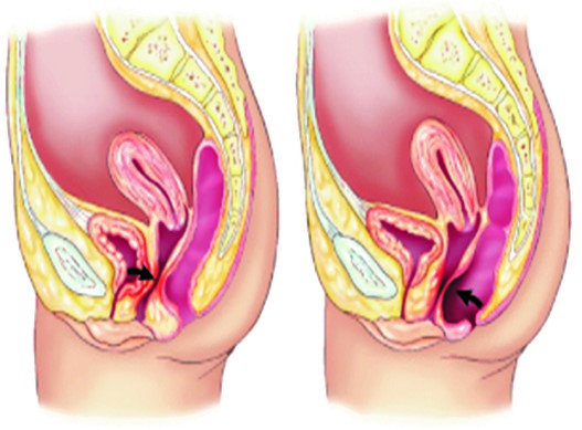 افتادگي رحم